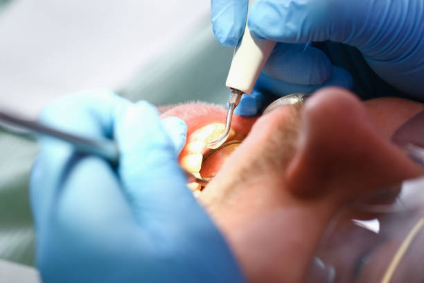Best Emergency Wisdom Tooth Extraction in Lake Mohawk, NJ